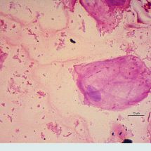 Obr. 1 - Mikroskopický snímek vaginálního stěru (barveno dle Grama; zvětšení 1600x)